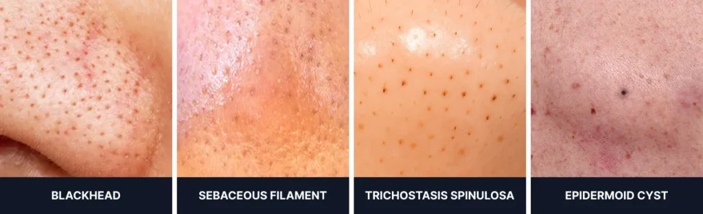Comparison of blackhead look-alikes: sebaceous filaments, trichostasis spinulosa, and epidermoid cyst