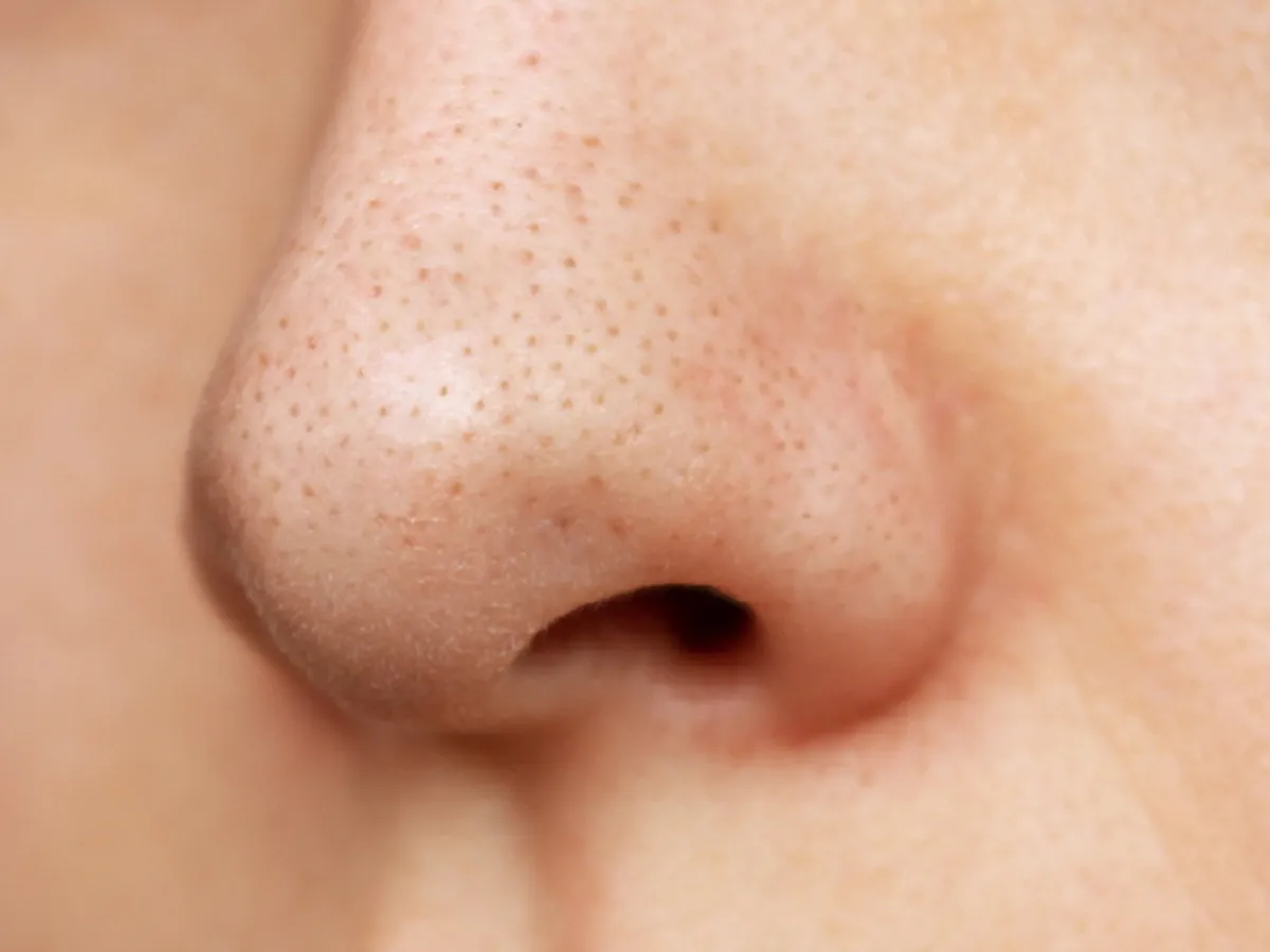 Close-up view of blackheads on nose