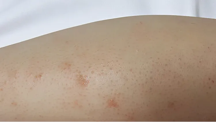 Close-up of a leg with hyperpigmentation, keratosis pilaris, and razor bumps