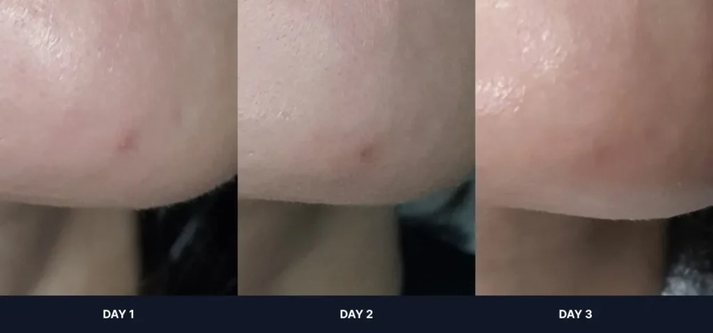Before and after results of using CNP bye od-td Spot Calming Gel