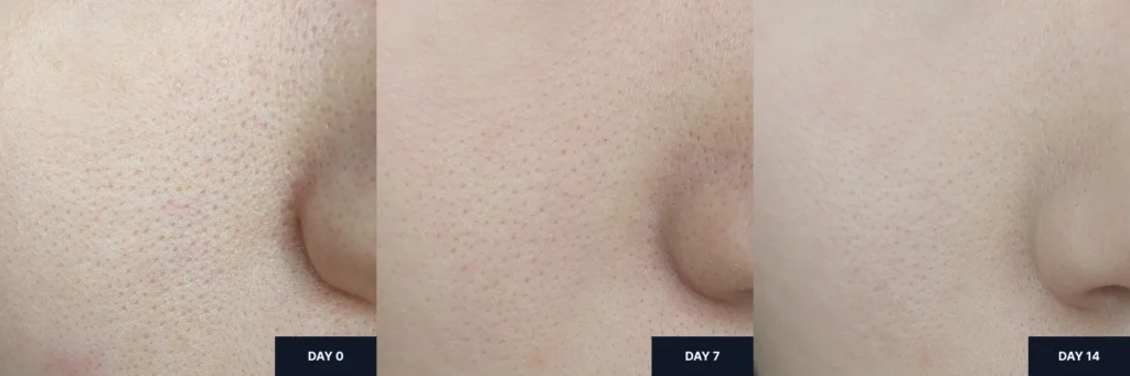 Side-by-side before and after images showing visible improvement in cheek texture and clarity after weekly use of Carenology Reborn 35% Acid Wash Off Peel