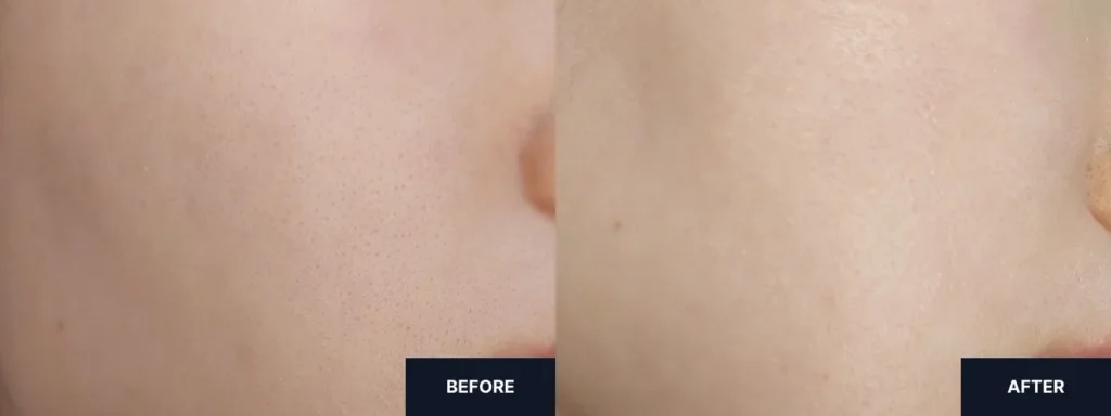Before and after effects of Hanyul Pure Artemisia Calming Water Cream on skin redness