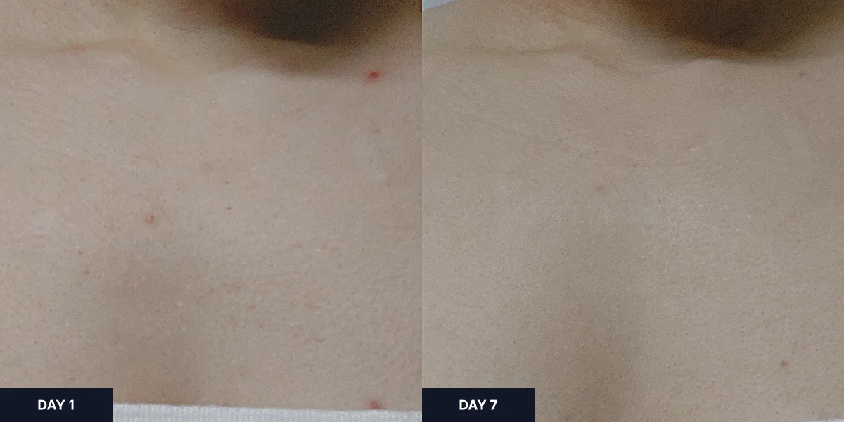 Before and after results of using Parnell Cicamanu Acne Body Wash for one week, showing improvement in chest acne