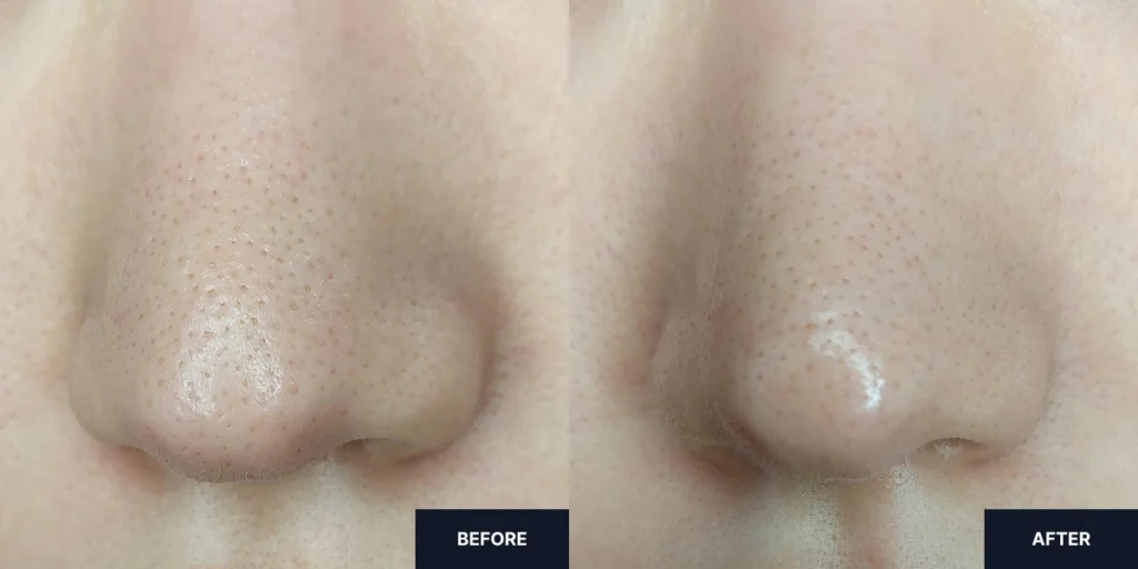 Side-by-side before and after images showing no changes in blackheads and whitehead after immediate use of Carenology Reborn 35% Acid Wash Off Peel