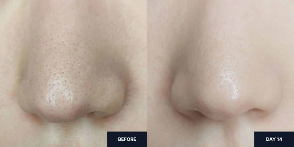 Before and after images showing a visible reduction in blackheads and whiteheads after 2 weeks of using Carenology Reborn 35% Acid Wash Off Peel