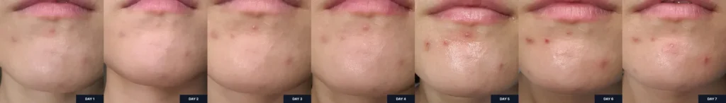 Before and after images for the first week of using Celladix Sebum Rebalancing Rx 131 Ampoule