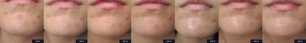 Before and after images for the second week of using Celladix Sebum Rebalancing Rx 131 Ampoule