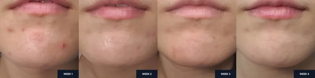 Before and after images 4 weeks after using Celladix Sebum Rebalancing Rx 131 Ampoule