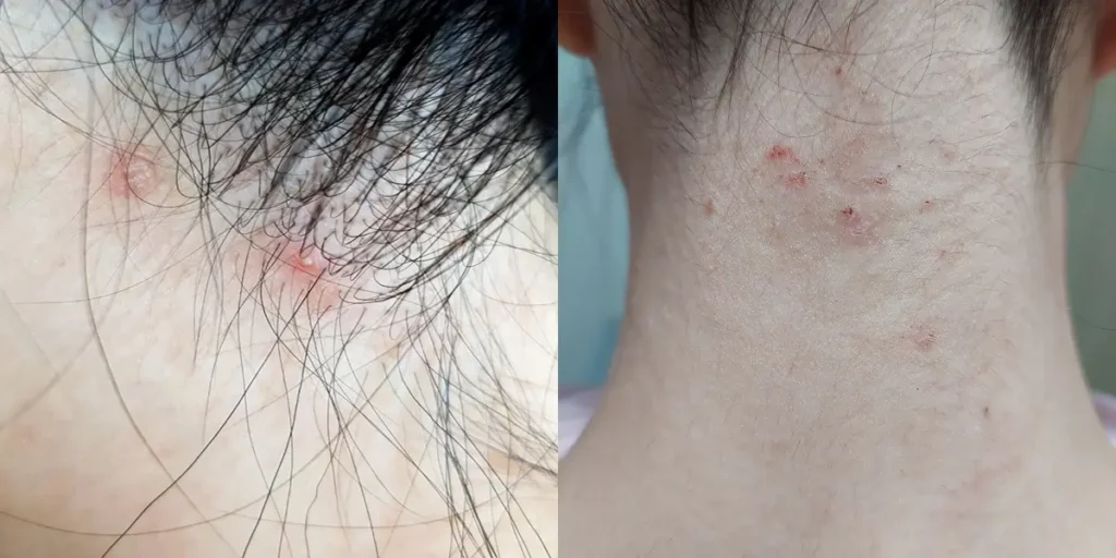 Mise En Scene curling essence caused breakouts on the neck