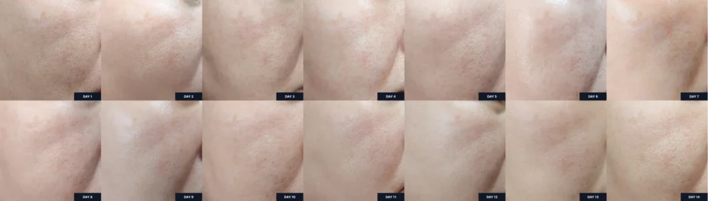Before and after images showing a visible reduction in dark spots and skin brightening effects after 2 weeks of using Sungboon Editor Active Marine Astaxanthin Cream