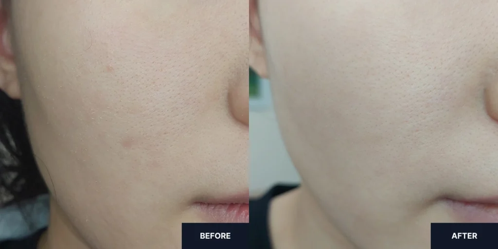 Improvements in dry skin after using Dr.Deep Multi Emulsion for 2 weeks