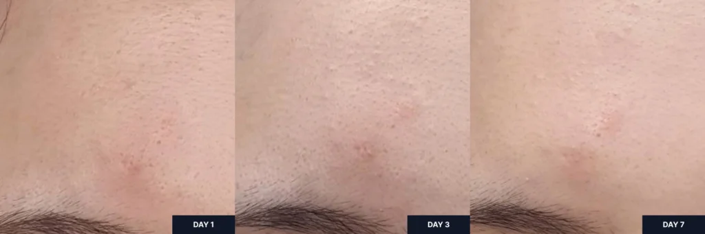 Bare Minimum Soothing Effects of Parnell 92 Serum on Inflamed Area Over 7 Days